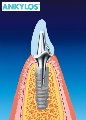 dental_implants3